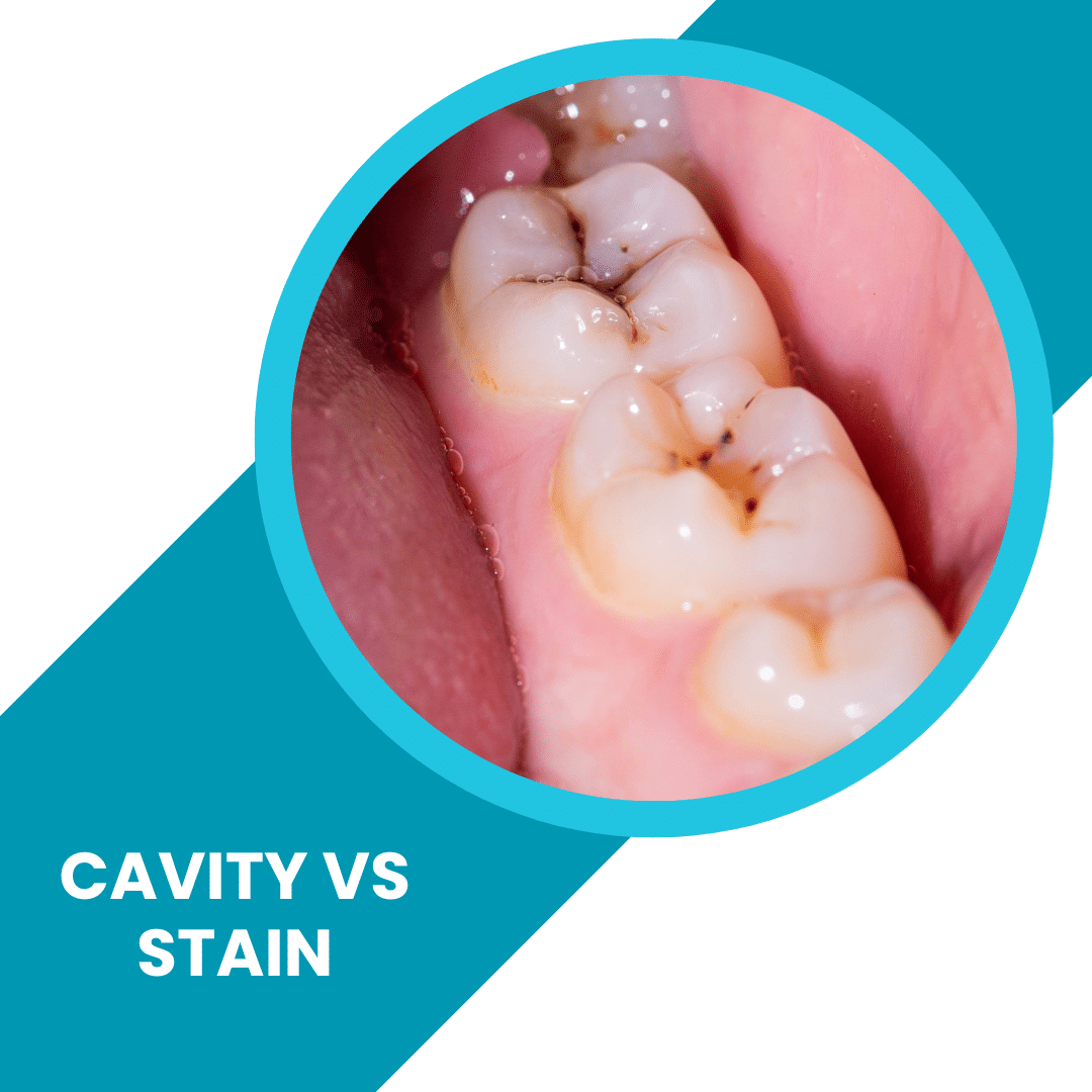 Cavity vs Stain Do you think you have a cavity?