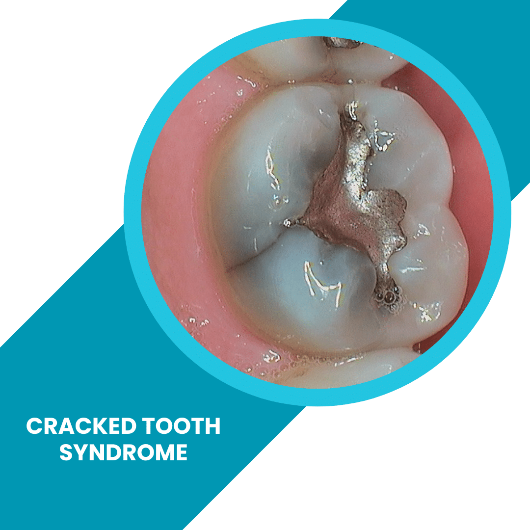 cracked-tooth-syndrome-what-are-the-symptoms