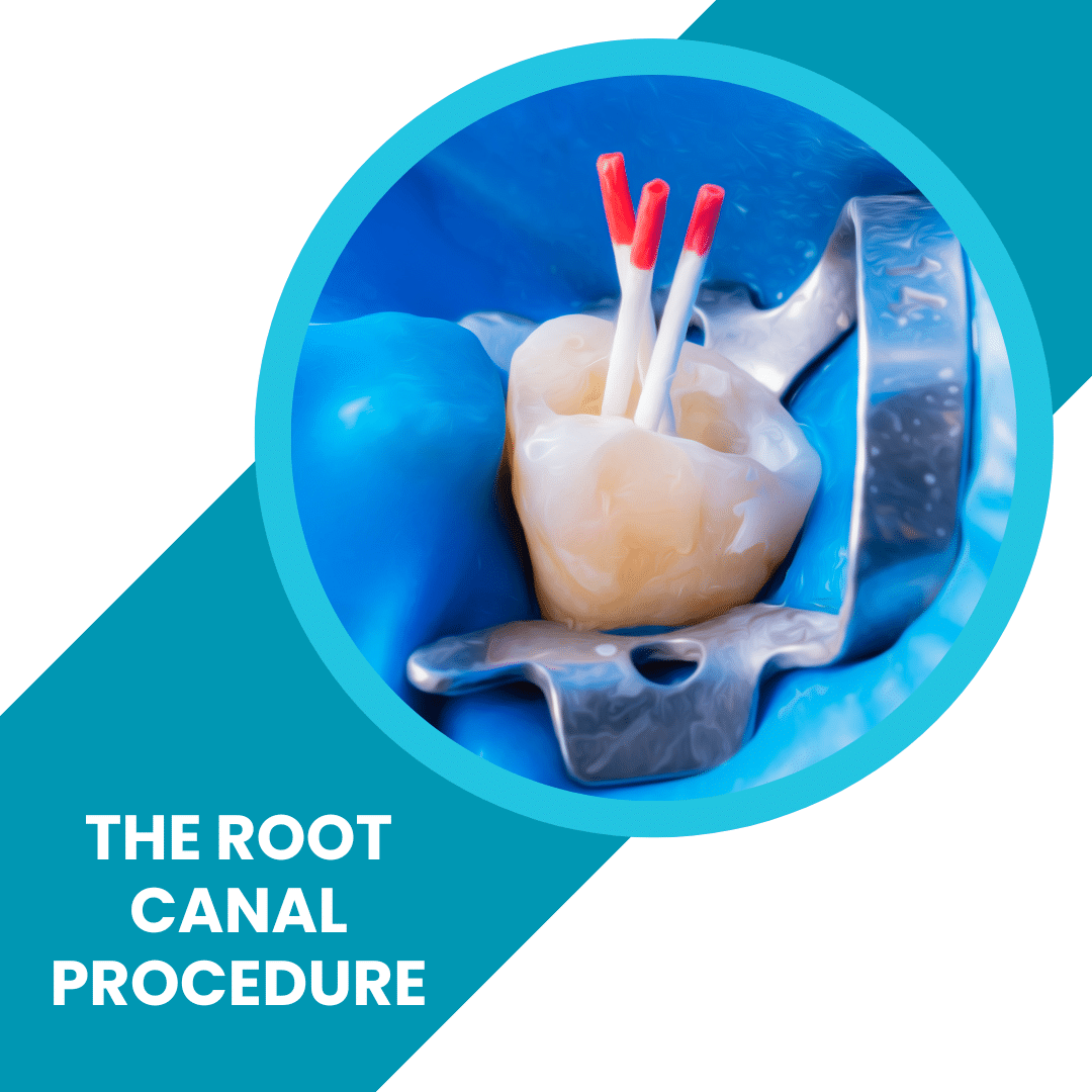 the-root-canal-procedure-how-much-is-a-root-canal